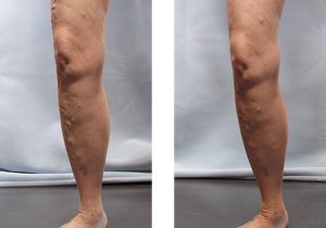 Treating Small Blue Veins