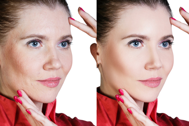 A Good Way to Get a Realistic Idea of What Cosmetic Treatments Can Do